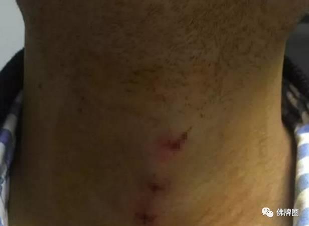 “被泰国师傅植入体内12枚护身符(符管),7年后来医院取出”聊聊国内假龙婆坤金针符管乱象!【泰国佛牌】 “被泰国师傅植入体内12枚护身符(符管),7年后来医院取出”聊聊国内假龙婆坤金针符管乱象!-图片2