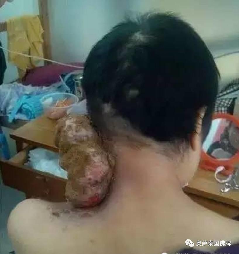 打蛇堕胎后颈部长巨瘤,又像婴儿又像蛇(附多张照片)【泰国佛牌】 打蛇堕胎后颈部长巨瘤,又像婴儿又像蛇(附多张照片)-图片1