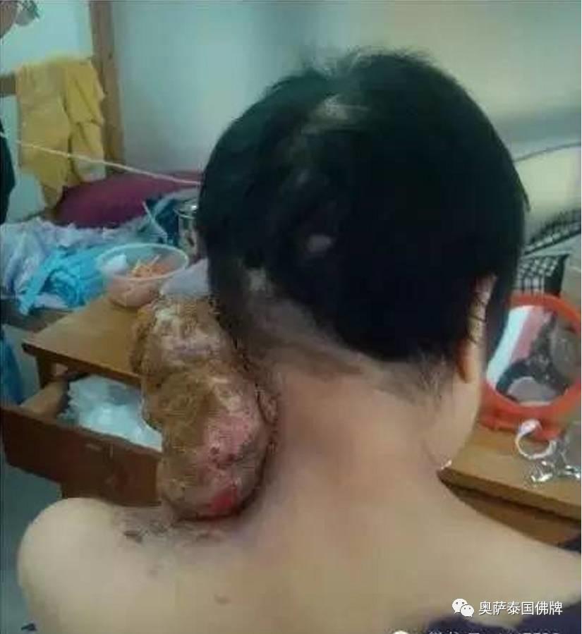打蛇堕胎后颈部长巨瘤,又像婴儿又像蛇(附多张照片)【泰国佛牌】 打蛇堕胎后颈部长巨瘤,又像婴儿又像蛇(附多张照片)-图片7