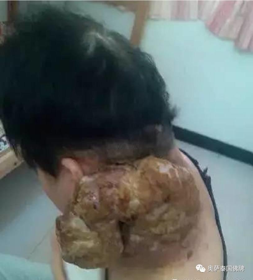 打蛇堕胎后颈部长巨瘤,又像婴儿又像蛇(附多张照片)【泰国佛牌】 打蛇堕胎后颈部长巨瘤,又像婴儿又像蛇(附多张照片)-图片2
