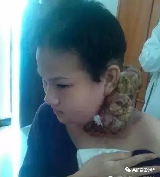 打蛇堕胎后颈部长巨瘤,又像婴儿又像蛇(附多张照片)【泰国佛牌】 打蛇堕胎后颈部长巨瘤,又像婴儿又像蛇(附多张照片)-图片3